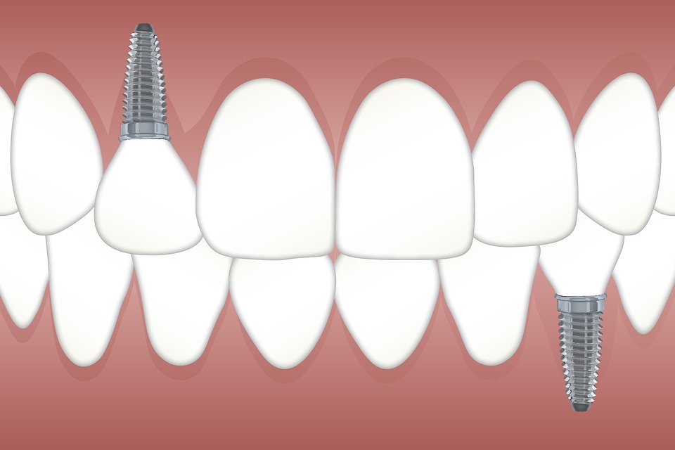 Proč zubní implantát?